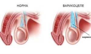 Как протекает операция при варикоцеле