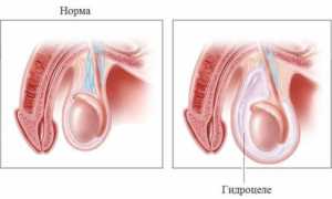 Как и в каких случаях проводится операция при гидроцеле?