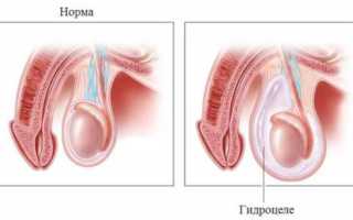 Как и в каких случаях проводится операция при гидроцеле?
