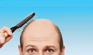 Известные методы борьбы с облысением у мужчин