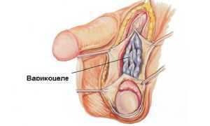 Какие осложнения возможны после операции варикоцеле?