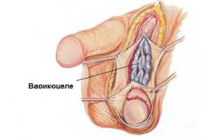 Какие осложнения возможны после операции варикоцеле?