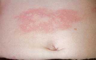 Появление прыщей на животе у мужчин: причины и лечение