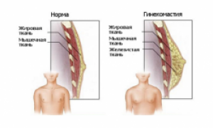 Мужская гинекомастия: операция – единственный выход