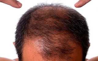 Что делать, если лысеет макушка?