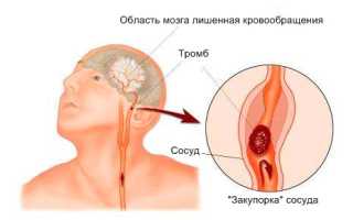 Правильное лечение и питание после инсульта
