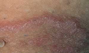 Причины покраснения в паху у мужчин