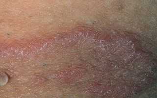 Причины покраснения в паху у мужчин