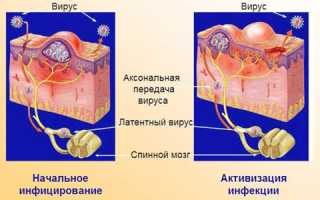 Лечение и профилактика герпеса гениталиум у мужчин