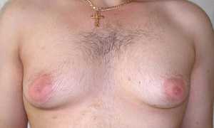 Что делать, если растет грудь у мужчины?