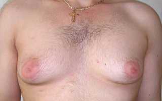 Что делать, если растет грудь у мужчины?