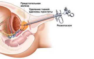 Домашнее лечение аденомы простаты народными средствами