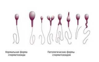 Причины и лечение тератозооспермии
