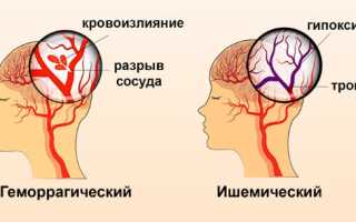 Восстановление речи после перенесенного инсульта