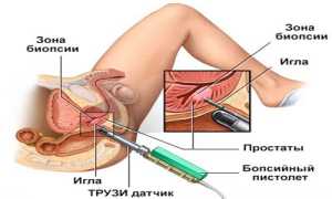 Процедура ТРУЗИ предстательной железы: отзывы
