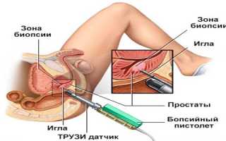 Процедура ТРУЗИ предстательной железы: отзывы