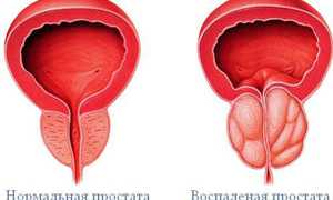 «Простата Форте Мен’с Формула»: все о препарате