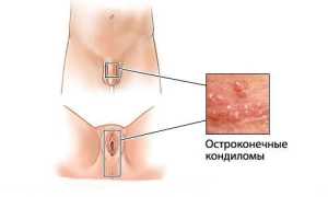 Остроконечные кондиломы у мужчин