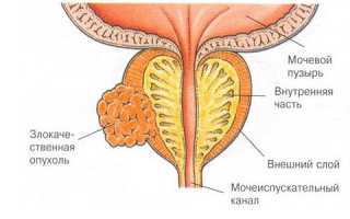 Эффективность лучевой терапии при раке предстательной железы