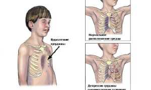 Как лечится впалая грудная клетка у мужчин?