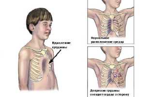 Как лечится впалая грудная клетка у мужчин?