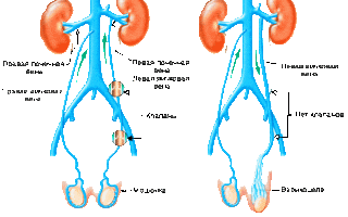Особенности эндоскопической операции при варикоцеле