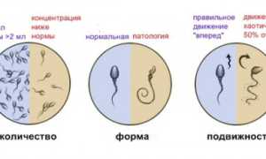 Что такое астеноолигозооспермия?