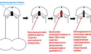Лечение короткой уздечки у мужчин