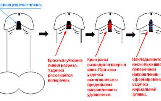Лечение короткой уздечки у мужчин