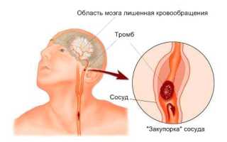 Признаки и предвестники инсульта у мужчин