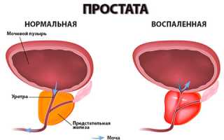 Можно ли вылечить хронический простатит?