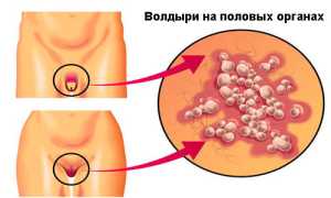 Как лечить волдыри на половом члене?