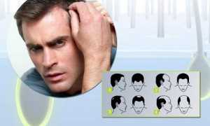 Почему сильно и быстро выпадают волосы у мужчин?