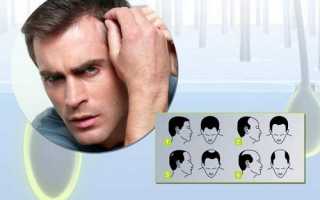 Почему сильно и быстро выпадают волосы у мужчин?
