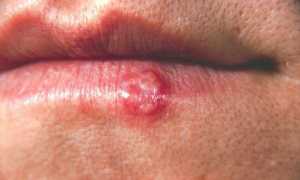 Особенности появления герпеса на губах у мужчин