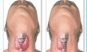 Гипотиреоз: причины возникновения у мужчин