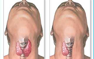 Гипотиреоз: причины возникновения у мужчин