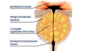 Какие упражнения при аденоме предстательной железы наиболее эффективны?