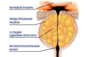 Какие упражнения при аденоме предстательной железы наиболее эффективны?