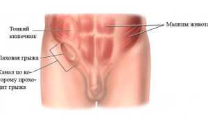 Как производится лечение паховой грыжи у мужчин?