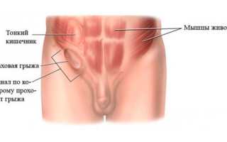 Как производится лечение паховой грыжи у мужчин?