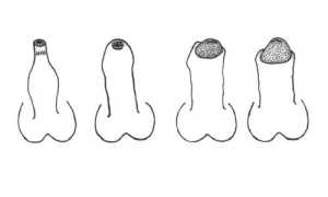 Почему появляется и как лечится рубцовый фимоз?