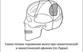 Семантическая афазия: актуальные причины, симптомы, лечение