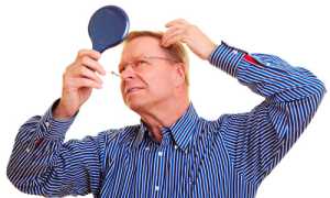 Почему выпадают волосы у мужчин: что делать для предотвращения облысения