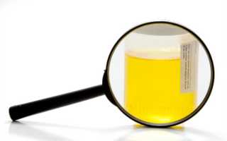 Почему появляются белые хлопья в моче у мужчин?