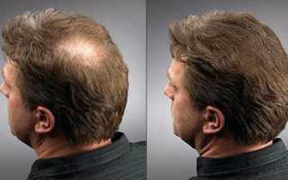 Как осуществить восстановление волос: рекомендации мужчинам