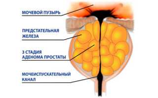 Что такое аденома предстательной железы: операция и отзывы
