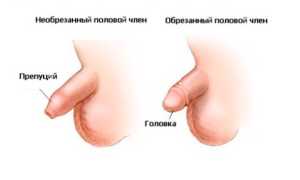 Преимущества проведения циркумцизио