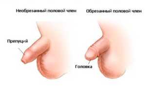 Преимущества проведения циркумцизио