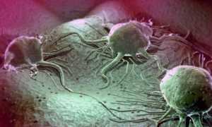 Почему появляется опухоль в паху у мужчин?